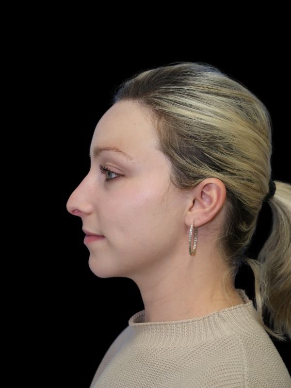 Rhinoplasty Before & After