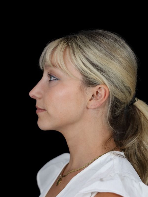 Rhinoplasty Before & After