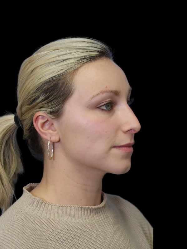 Rhinoplasty Before & After