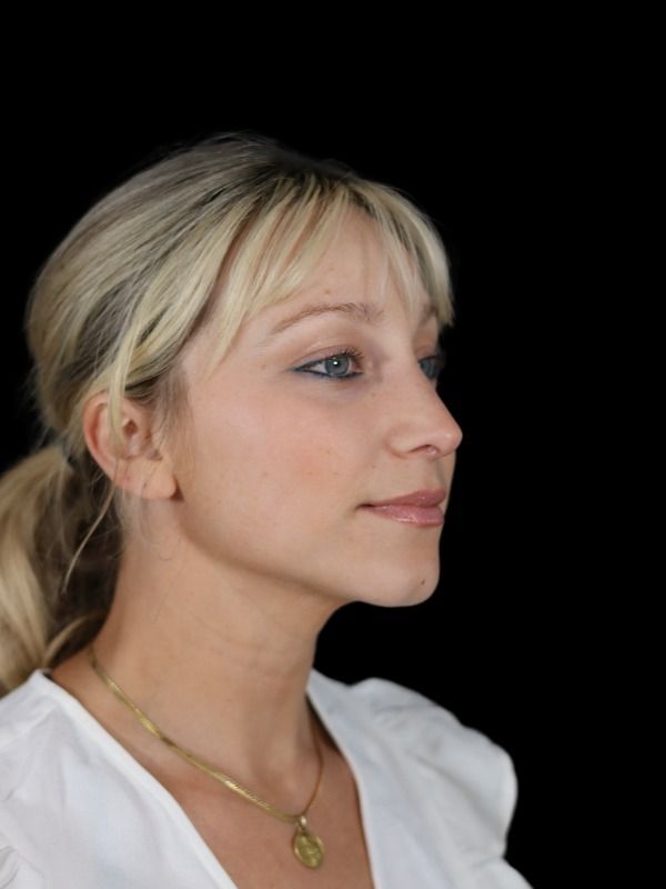 Rhinoplasty Before & After