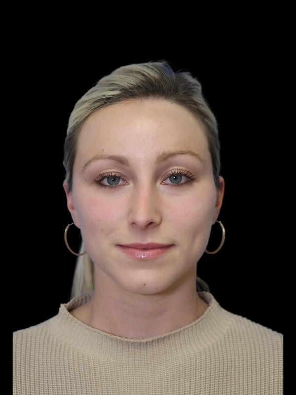 Rhinoplasty Before & After