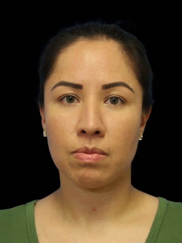 Rhinoplasty Before & After