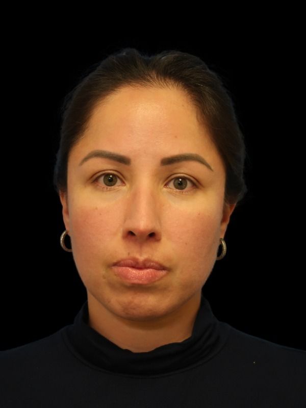 Rhinoplasty Before & After