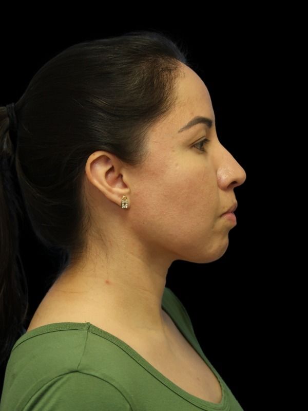 Rhinoplasty Before & After