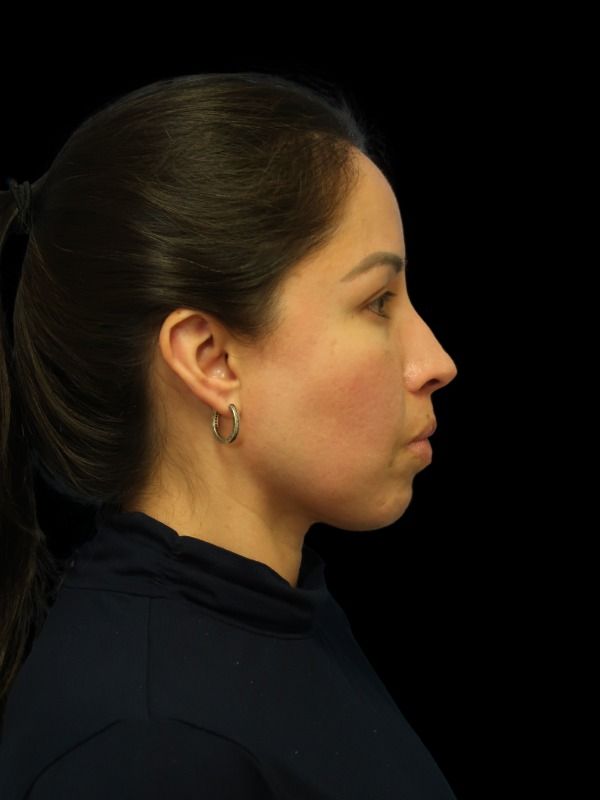 Rhinoplasty Before & After