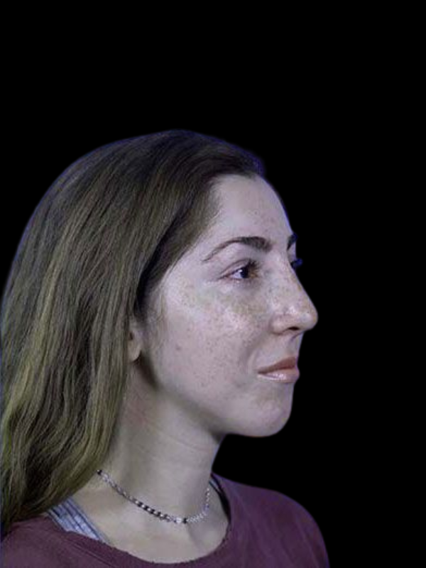 Rhinoplasty Before & After