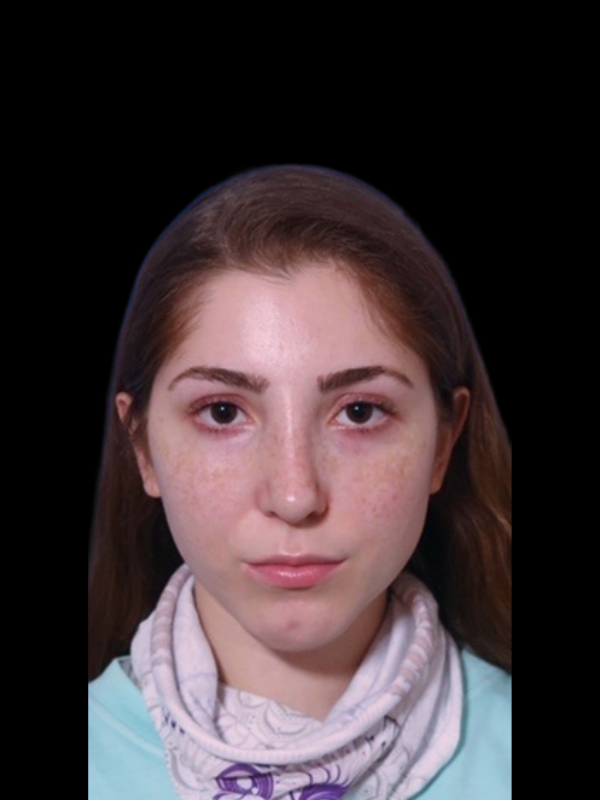 Rhinoplasty Before & After