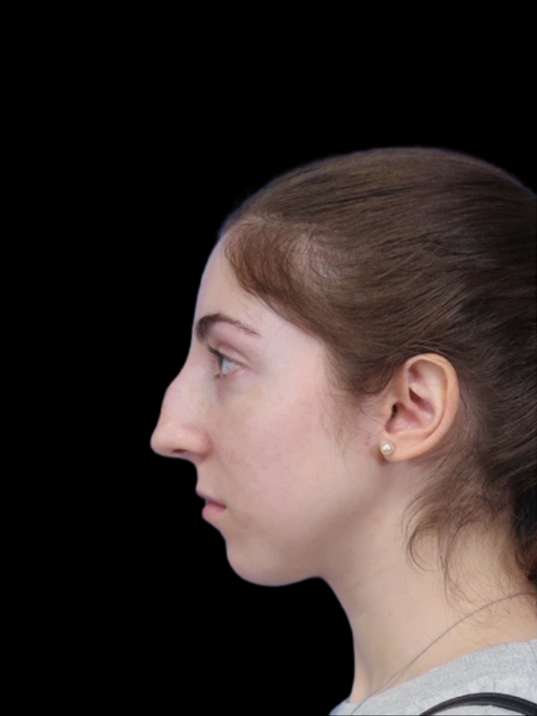 Rhinoplasty Before & After