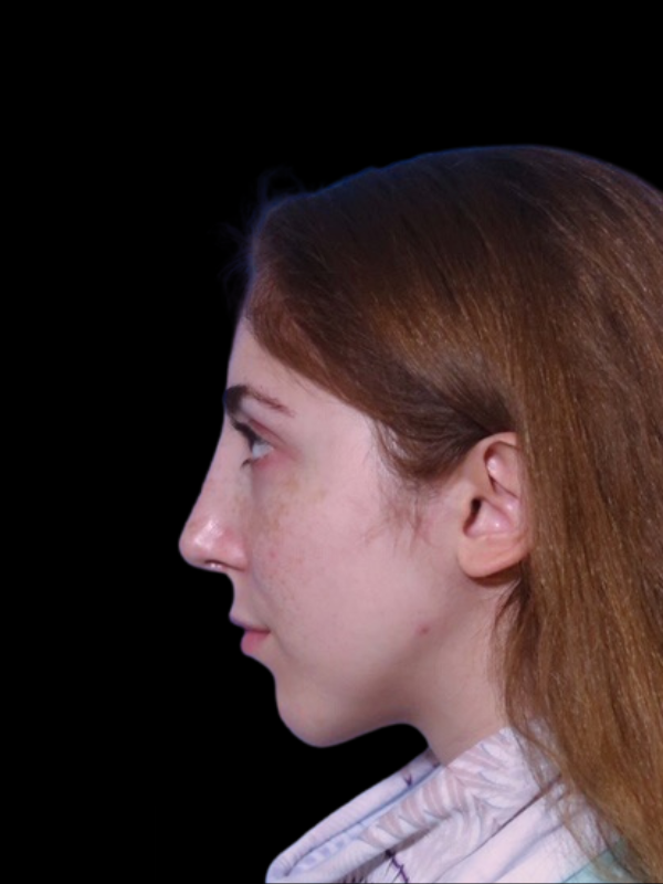 Rhinoplasty Before & After