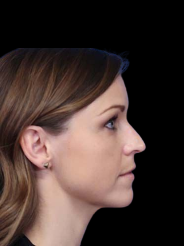 Rhinoplasty Before & After