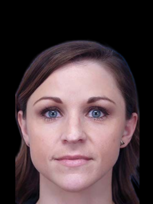 Rhinoplasty Before & After