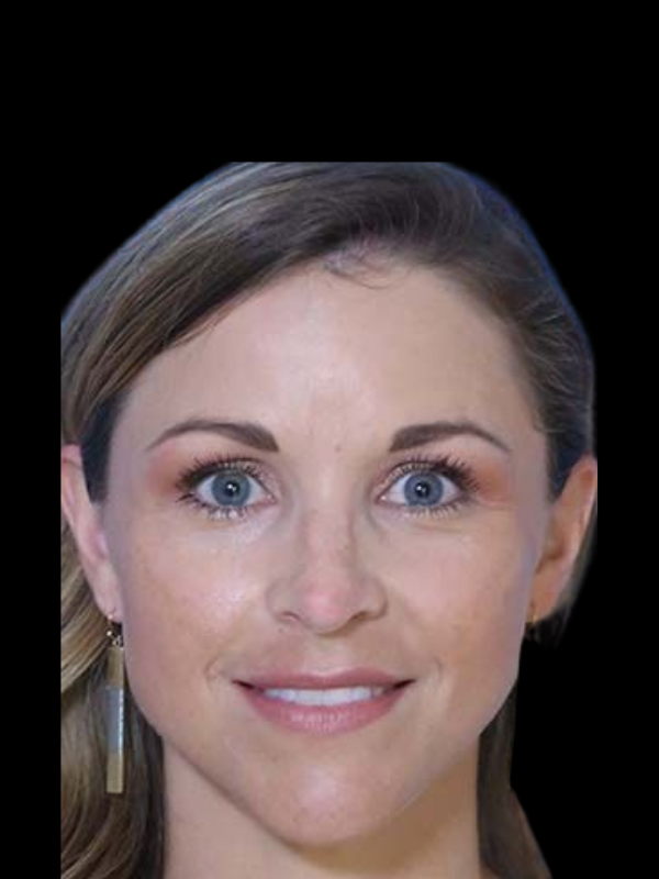 Rhinoplasty Before & After