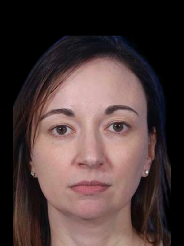 Rhinoplasty Before & After