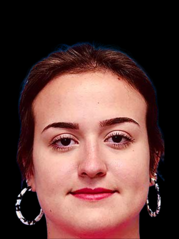 Rhinoplasty Before & After