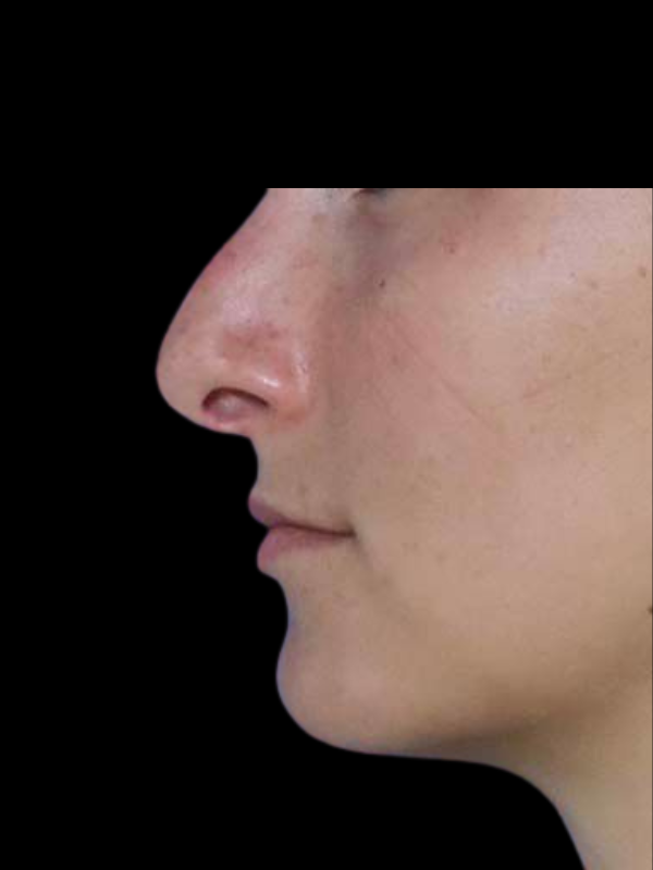 Rhinoplasty Before & After