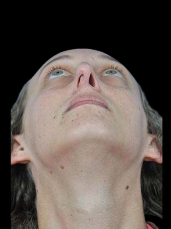 Rhinoplasty Before & After