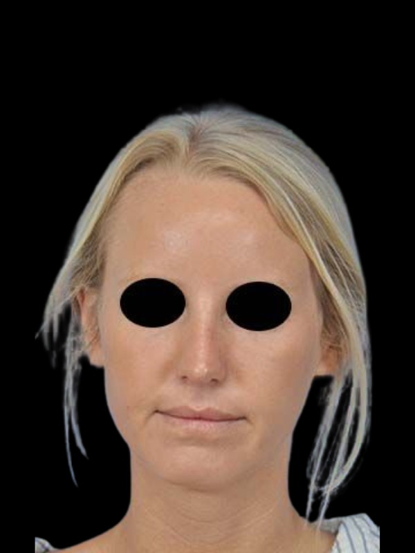 Rhinoplasty Before & After