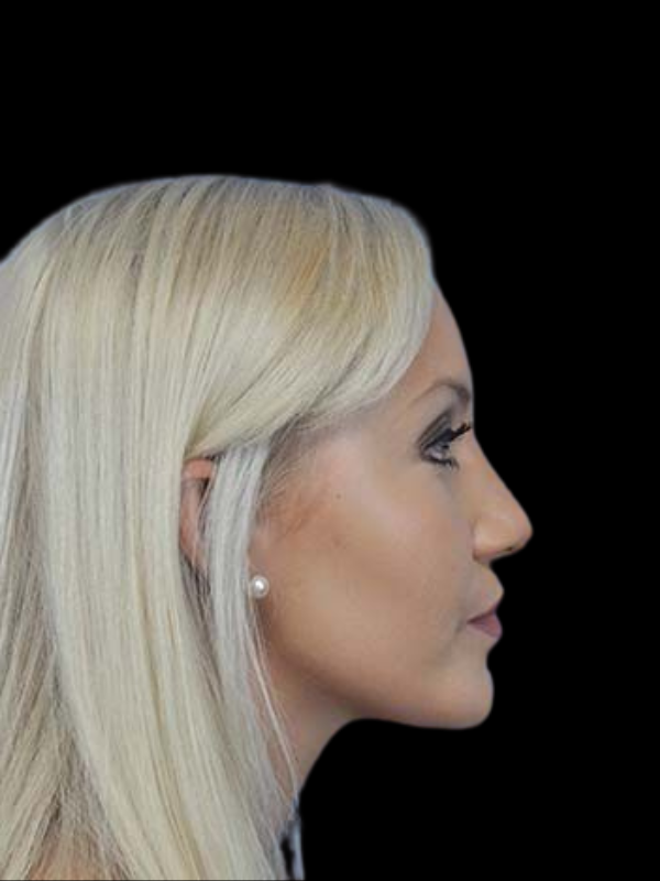 Rhinoplasty Before & After