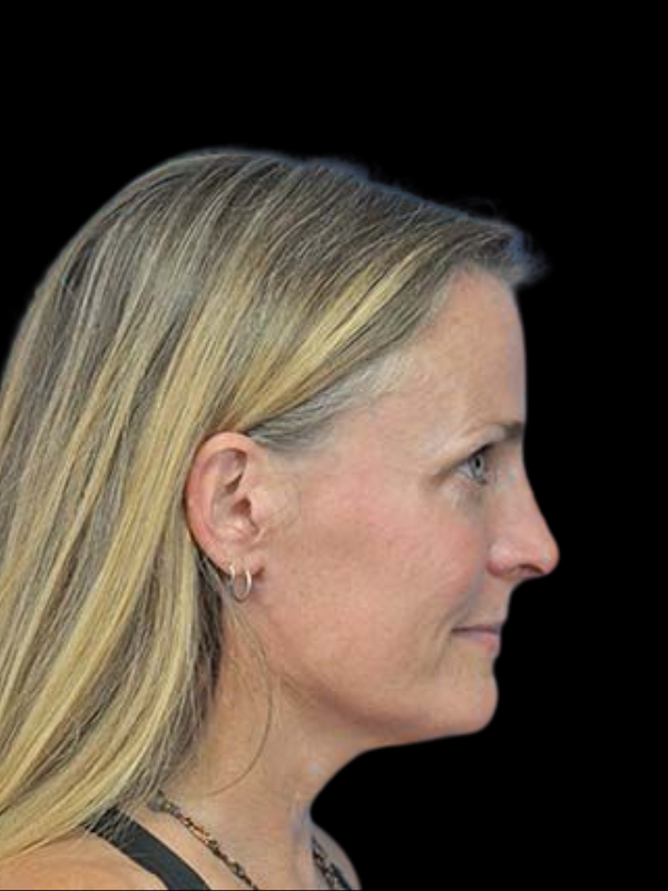 Rhinoplasty Before & After