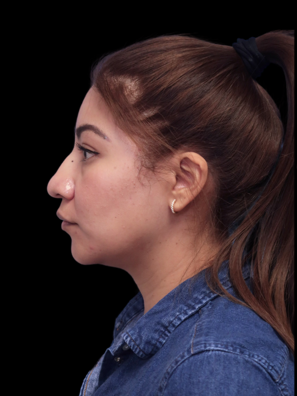 Rhinoplasty Before & After