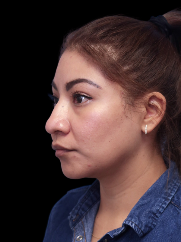 Rhinoplasty Before & After