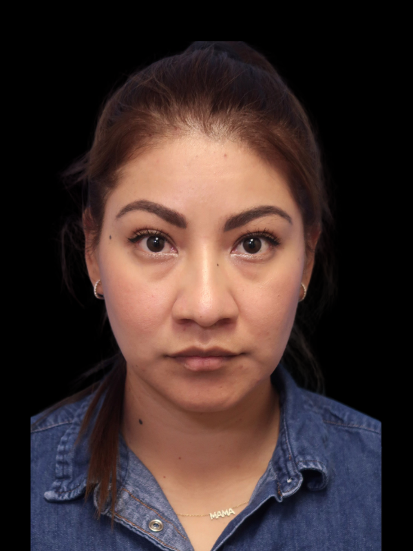 Rhinoplasty Before & After