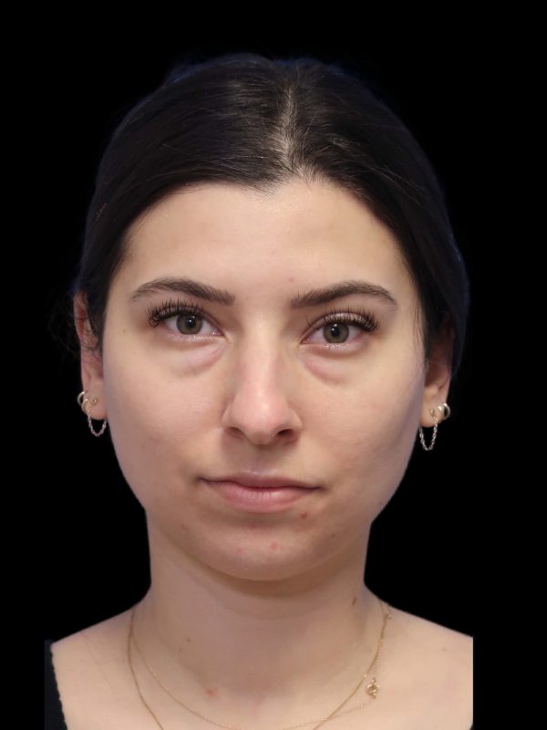 Rhinoplasty Before & After