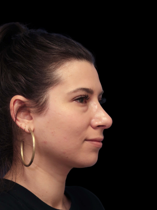 Rhinoplasty Before & After