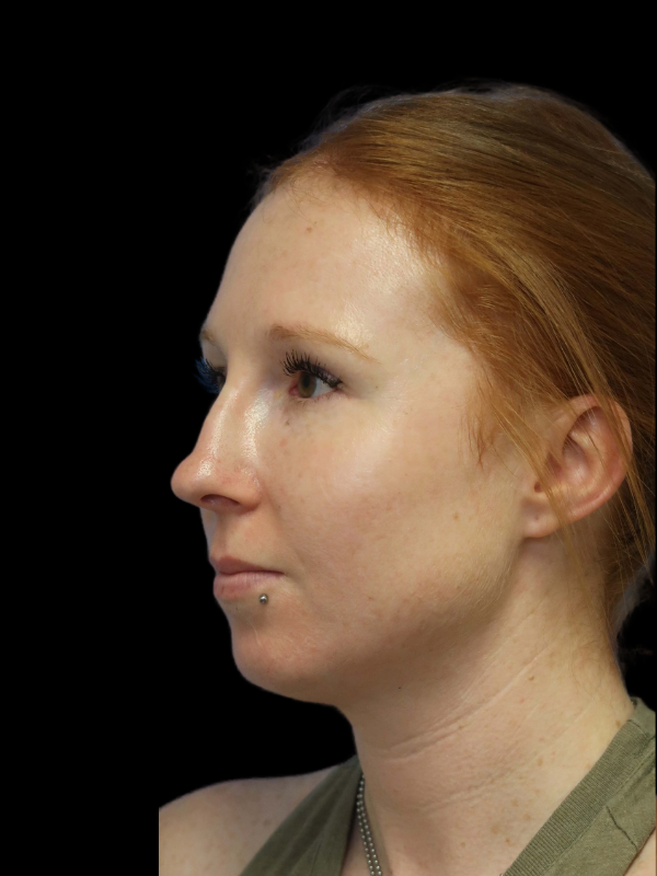 Rhinoplasty Before & After
