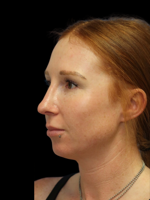 Rhinoplasty Before & After