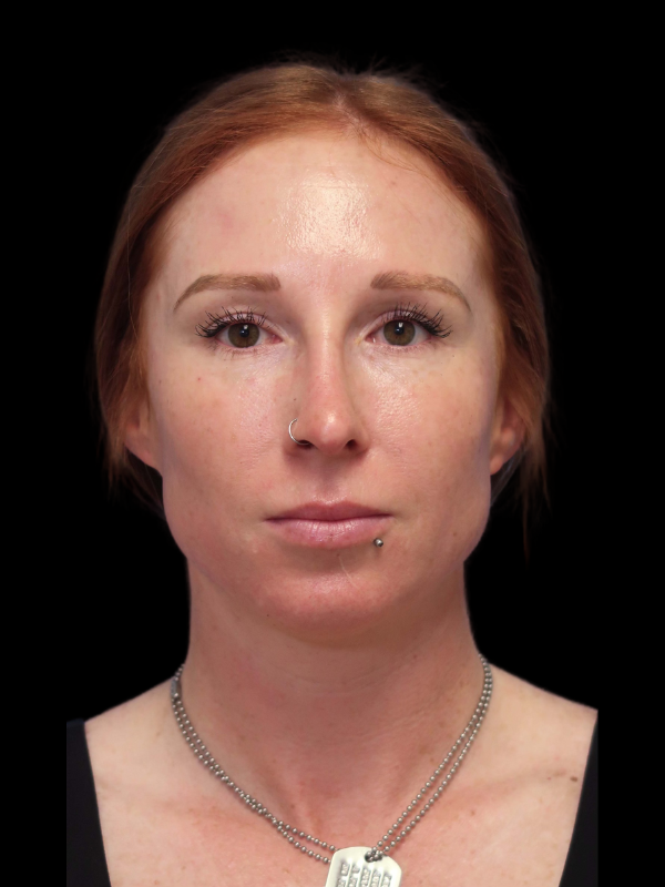 Rhinoplasty Before & After