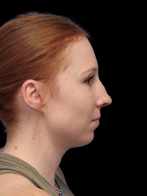 Rhinoplasty Before & After