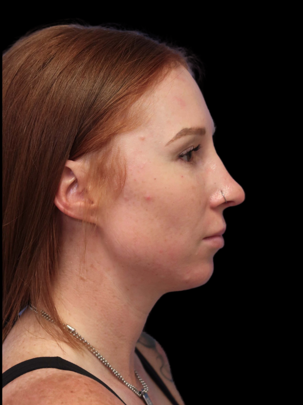 Rhinoplasty Before & After
