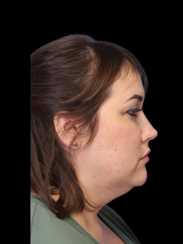 Rhinoplasty Before & After