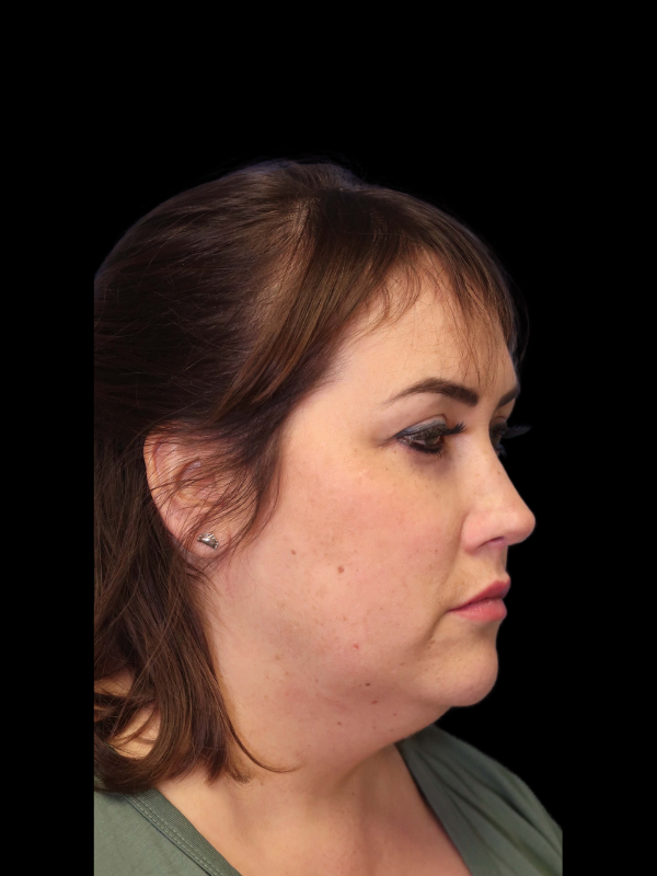 Rhinoplasty Before & After