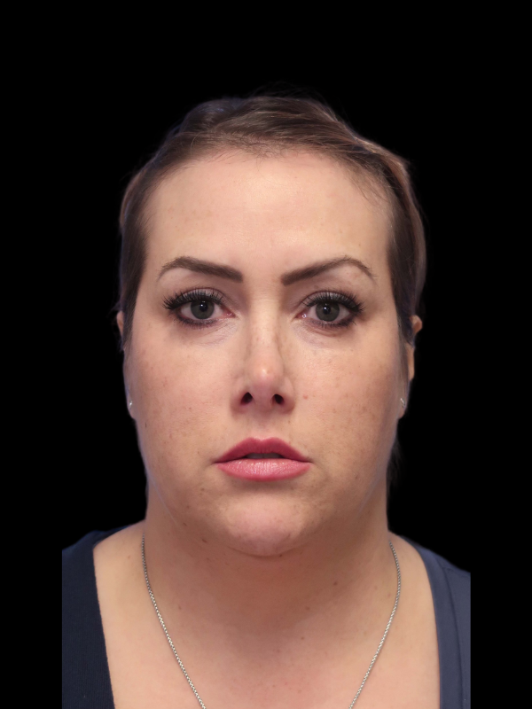 Rhinoplasty Before & After