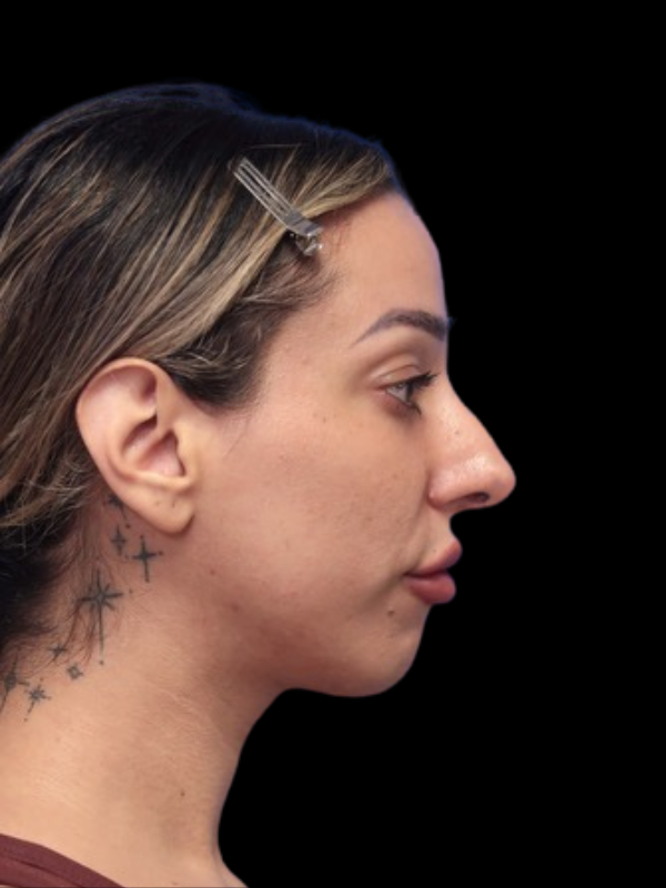 Rhinoplasty Before & After