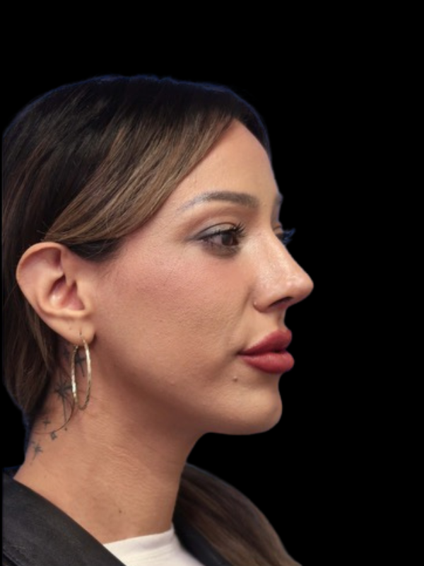 Rhinoplasty Before & After