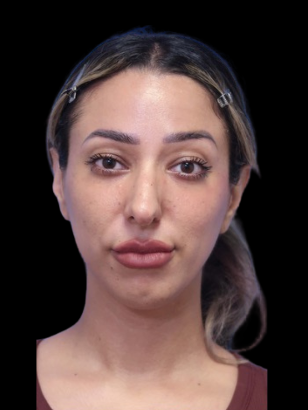 Rhinoplasty Before & After