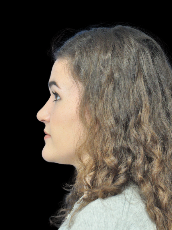 Rhinoplasty Before & After