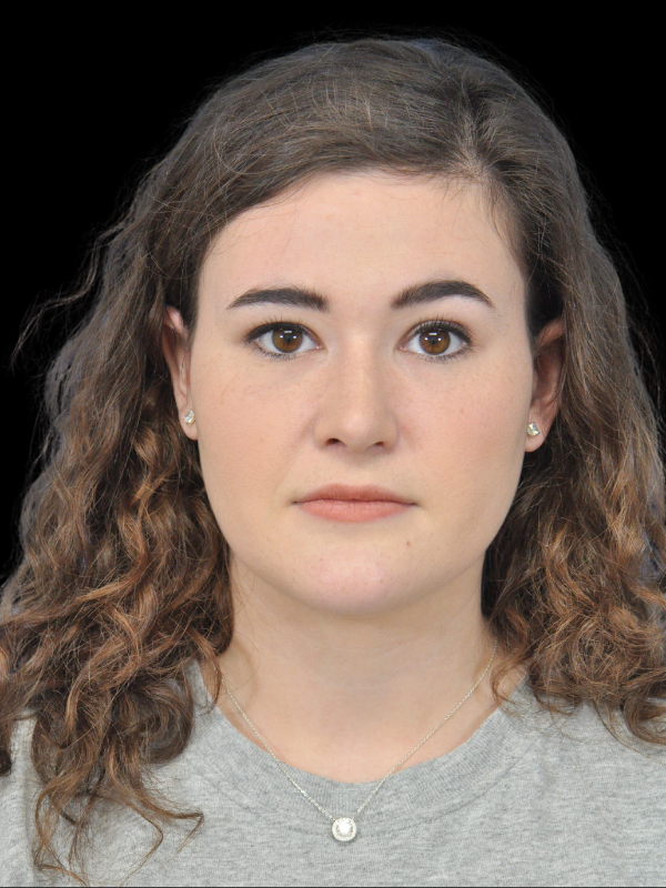 Rhinoplasty Before & After