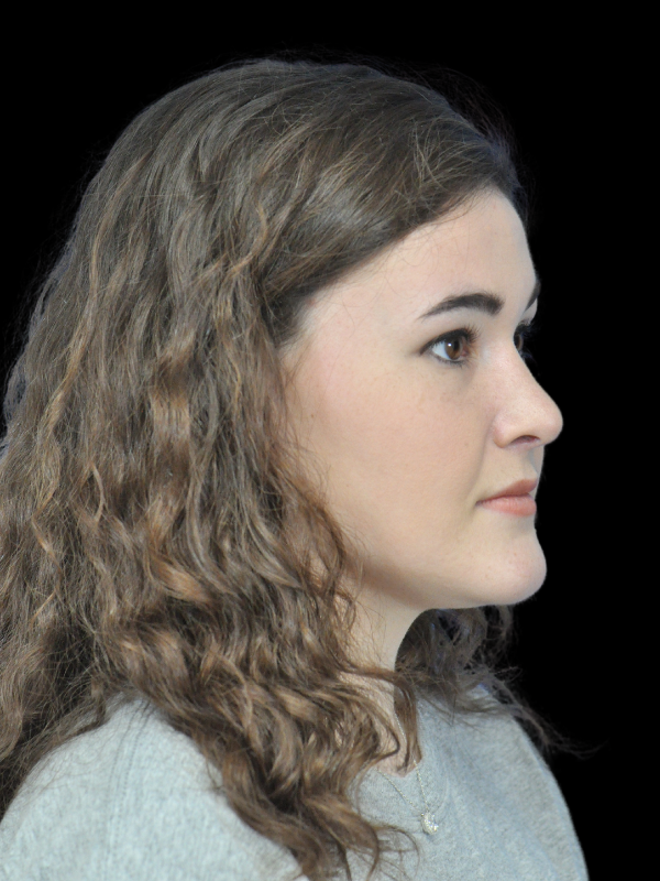 Rhinoplasty Before & After