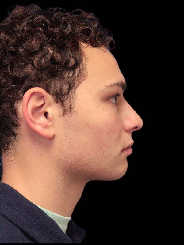 Rhinoplasty Before & After