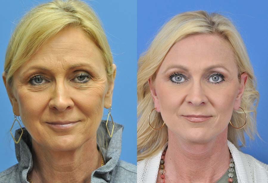 facelift before and after