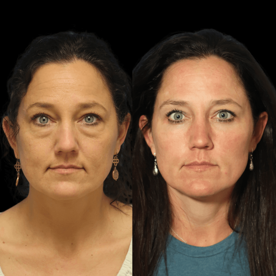 blepharoplasty before and after