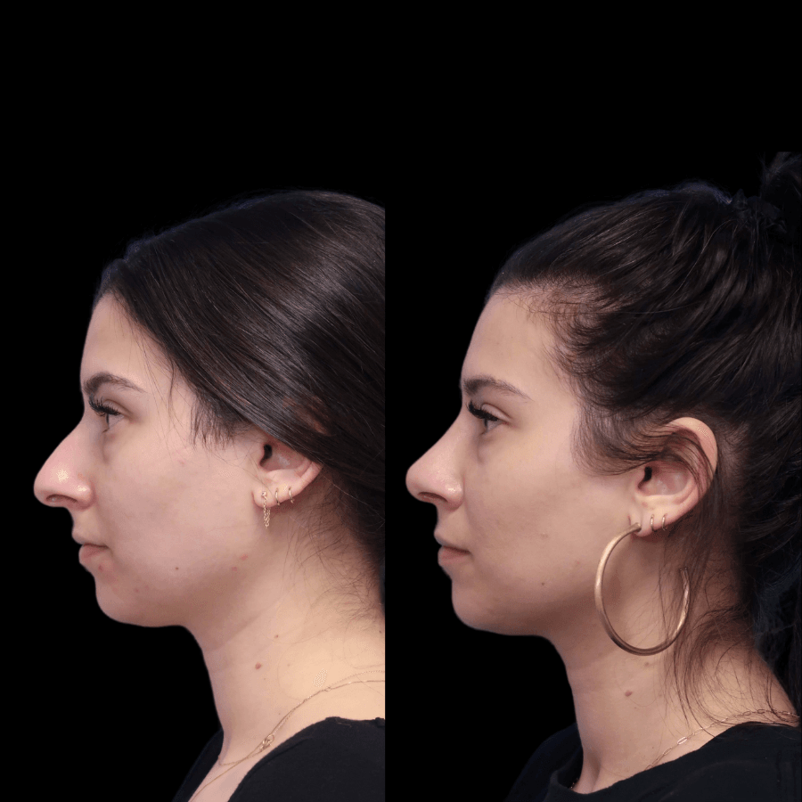 rhinoplasty before and after